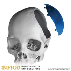 CRANIO MAXILLO FACIAL IMPLANTS 3D Printed patient-specific 